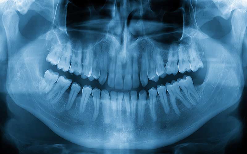 dental X-Ray